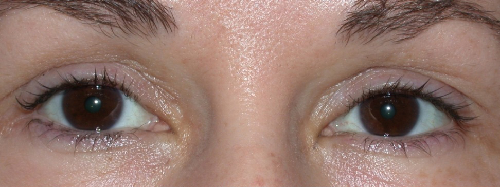Eyeliner Micropigmentation