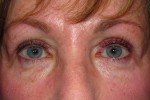 Eyelid and Upper Facial Surgery