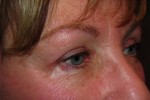 Eyelid and Upper Facial Surgery