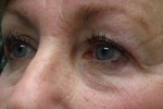 Eyelid and Upper Facial Surgery