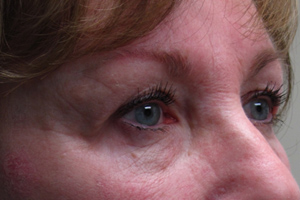 Eyelid and Upper Facial Surgery