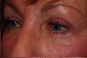 Eyelid and Upper Facial Surgery