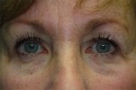 Eyelid and Upper Facial Surgery