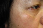 Laser to Remove Brown Spots