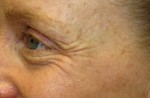 Botox, Daxxify, Dysport