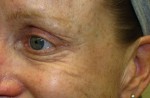 Botox, Daxxify, Dysport