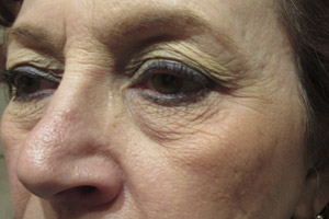 Eyelid and Upper Facial Surgery