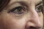 Eyelid and Upper Facial Surgery