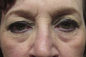 Eyelid and Upper Facial Surgery