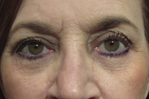 Eyelid and Upper Facial Surgery