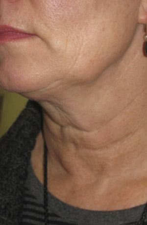 Skin Laser Resurfacing