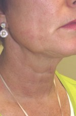Skin Laser Resurfacing
