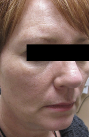 Skin Laser Resurfacing