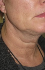 Skin Laser Resurfacing