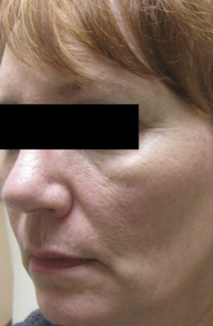 Skin Laser Resurfacing