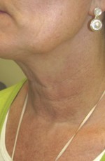 Skin Laser Resurfacing