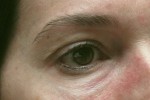 Eyelid and Upper Facial Surgery