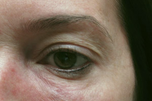 Eyelid and Upper Facial Surgery