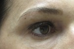 Eyelid and Upper Facial Surgery