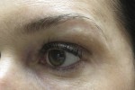 Eyelid and Upper Facial Surgery