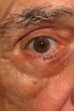 Eyelid and Upper Facial Surgery