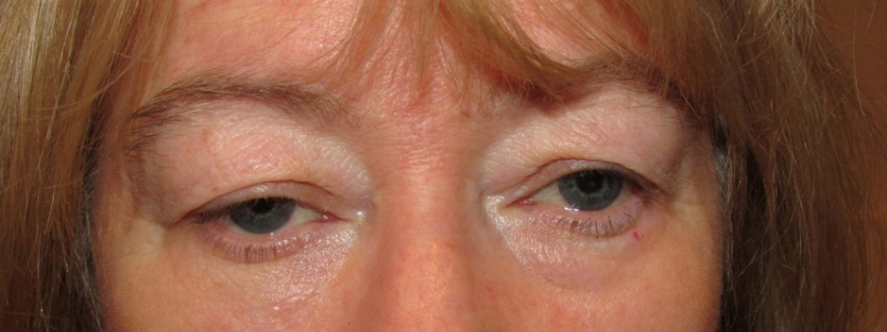 Eyelid and Upper Facial Surgery