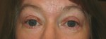 Eyelid and Upper Facial Surgery