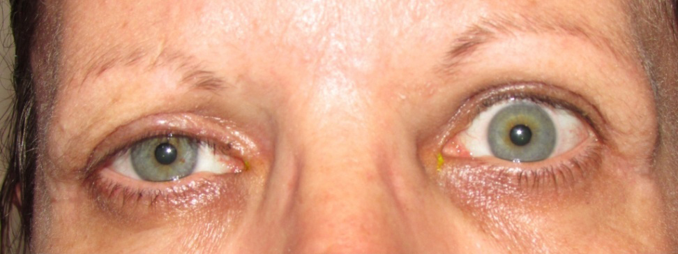 Eyelid and Upper Facial Surgery