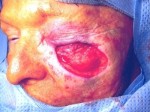 Skin Cancer Reconstruction