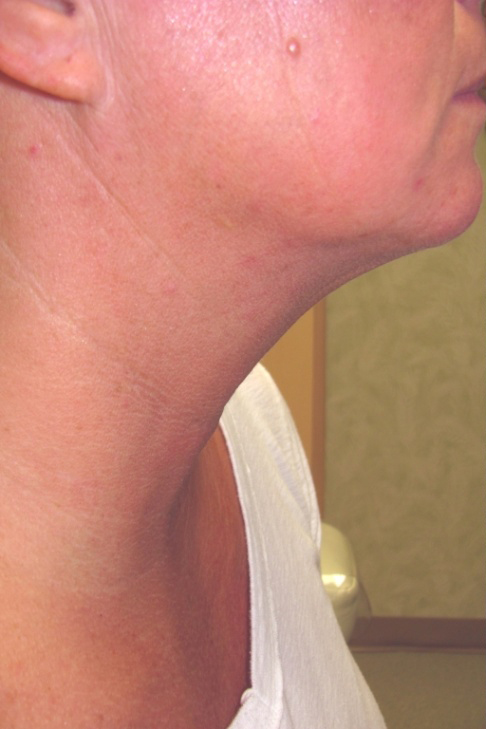 Neck Liposuction