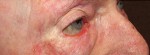 Eyelid and Upper Facial Surgery