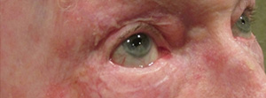 Eyelid and Upper Facial Surgery