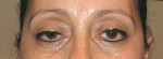 Eyelid and Upper Facial Surgery