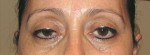 Eyelid and Upper Facial Surgery