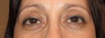 Eyelid and Upper Facial Surgery