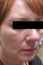 Skin Laser Resurfacing