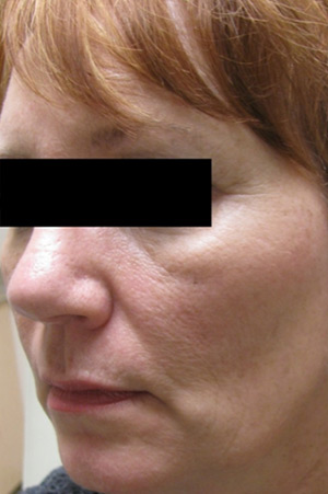 Skin Laser Resurfacing