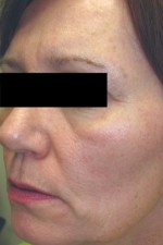 Skin Laser Resurfacing