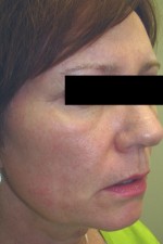 Skin Laser Resurfacing