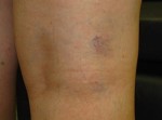 Sclerotherapy