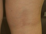 Sclerotherapy