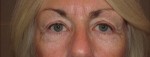 Eyelid and Upper Facial Surgery