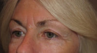 Eyelid and Upper Facial Surgery