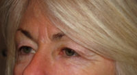 Eyelid and Upper Facial Surgery