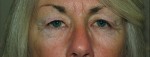 Eyelid and Upper Facial Surgery