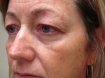 Eyelid and Upper Facial Surgery