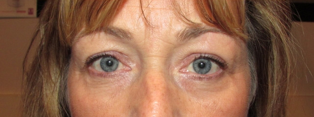 Eyelid and Upper Facial Surgery