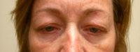 Eyelid and Upper Facial Surgery