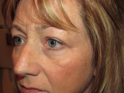 Eyelid and Upper Facial Surgery