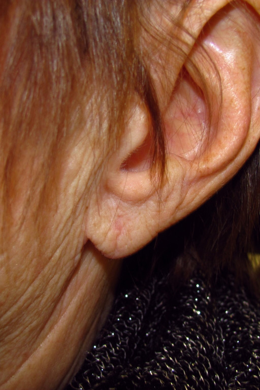 Earlobe Repair